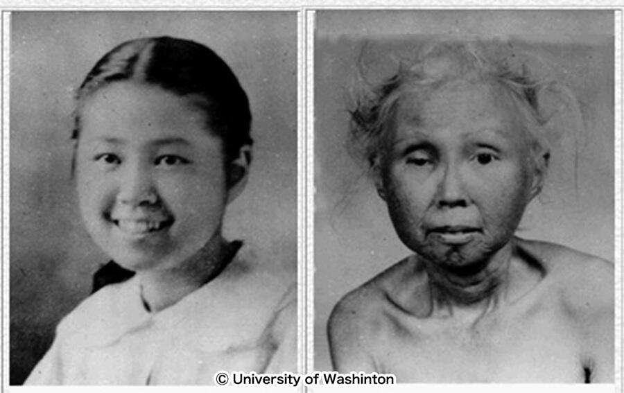New Hope for Patients with Werner Syndrome, Masaya KOSHIZAKA, Associate Professor, Center for Preventive Medical Sciences
